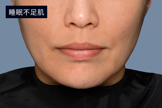 睡眠不足肌のイメージ